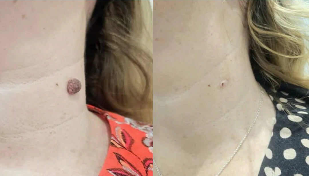 The KeraErase Dual-Action Cream - Non-Acidic Renewal for Warts, Tags, and Keratin Buildup + 50% OFF