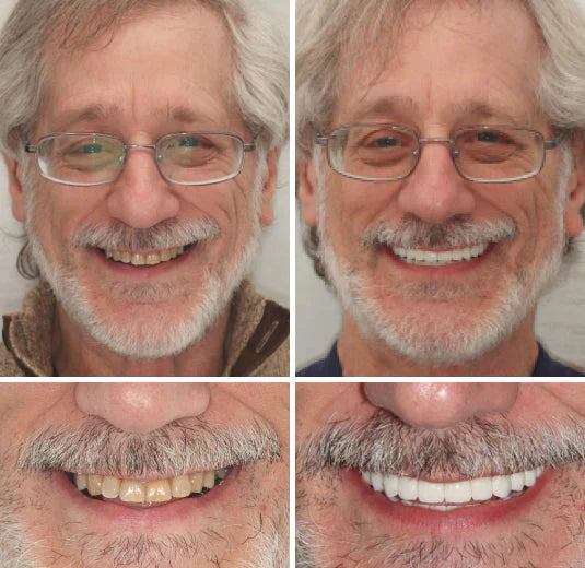 SmileFit Functional Denture Set- 50 % OFF