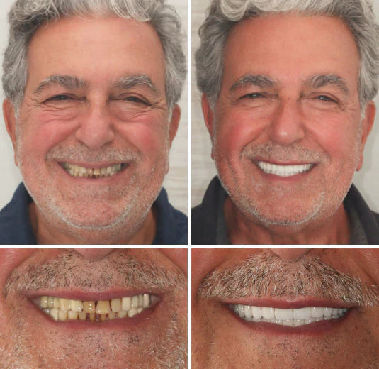 SmileFit Functional Denture Set- 50 % OFF