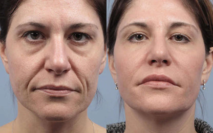 The Renewing 10s Instant-Lift Serum – Fast-Acting Lift for a Noticeably Younger Look in Seconds + 50% OFF