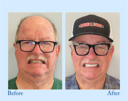 The BioShield Mineral Powder - Rebuild Your Enamel, End Sensitivity + 50% OFF