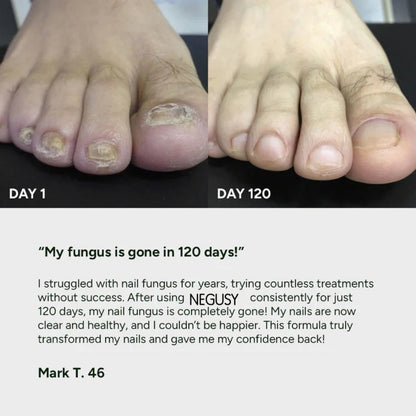 The AuraFungus Anti-Fungal Gel - Podiatrist-Recommended, 100% Organic, and 120-Day Guarantee + 50% OFF