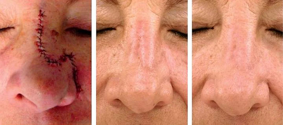 ScarRefine – Erase Scars & Restore Texture + 50% OFF TODAY