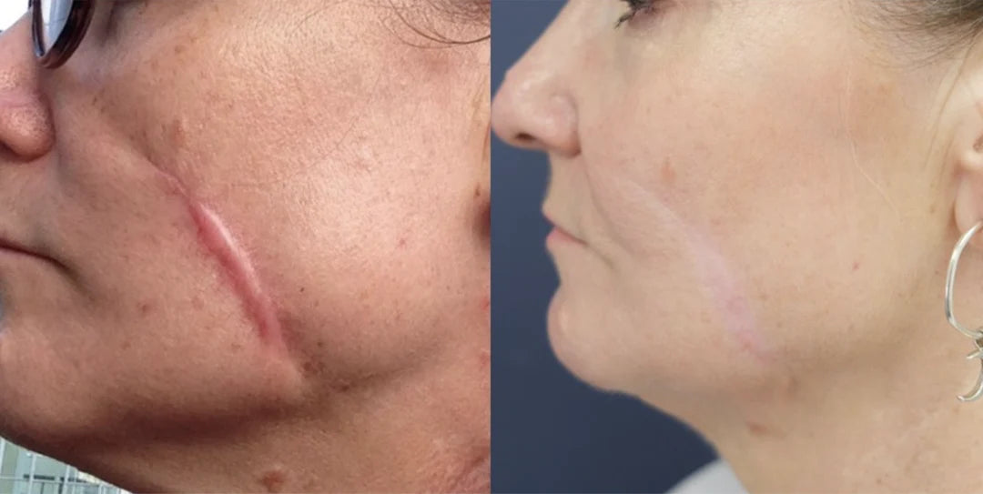 ScarRefine – Erase Scars & Restore Texture + 50% OFF TODAY