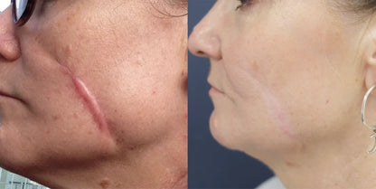 ScarRefine – Erase Scars & Restore Texture + 50% OFF TODAY