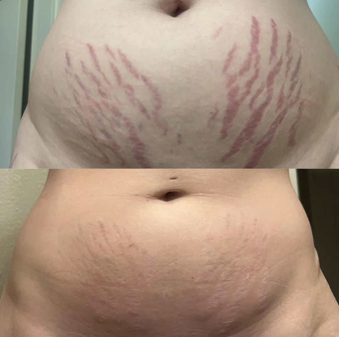 ScarRefine – Erase Scars & Restore Texture + 50% OFF TODAY