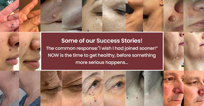 The KeraErase Dual-Action Cream - Non-Acidic Renewal for Warts, Tags, and Keratin Buildup + 50% OFF