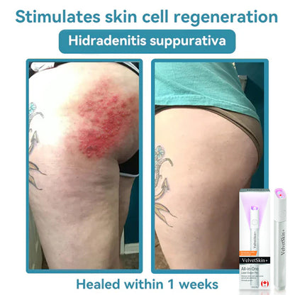 DermaBeam Pro – Erase Skin Flaws Instantly + 50% OFF