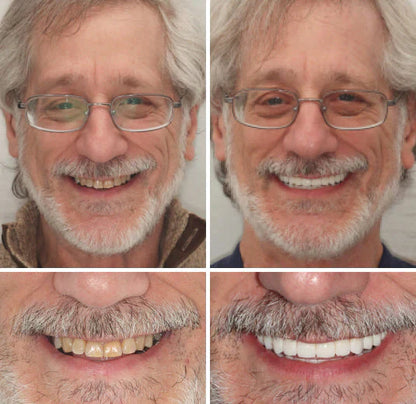 SmileFit Functional Denture Set- 50 % OFF