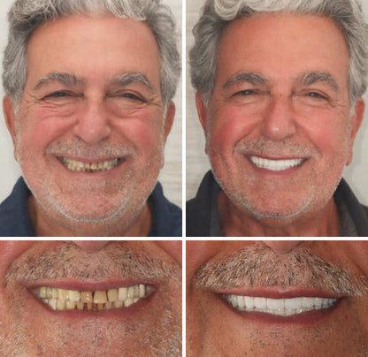 SmileFit Functional Denture Set- 50 % OFF