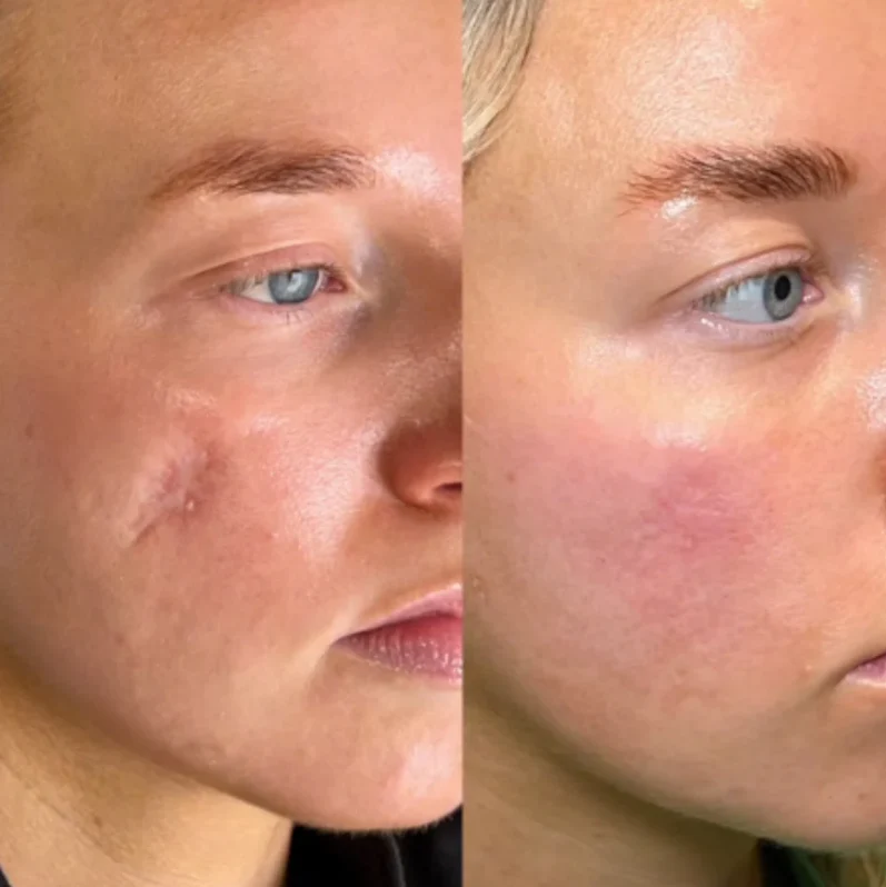 The AuraSmooth Scar Stick - 60% Medical-Grade Silicone, Centella Asiatica, and 100% Satisfaction Guarantee +50% OFF