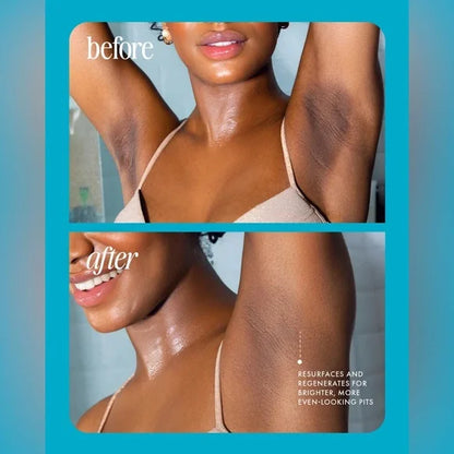 DermaCalm - The End of Ingrown Hairs & Razor Bumps - 50% OFF